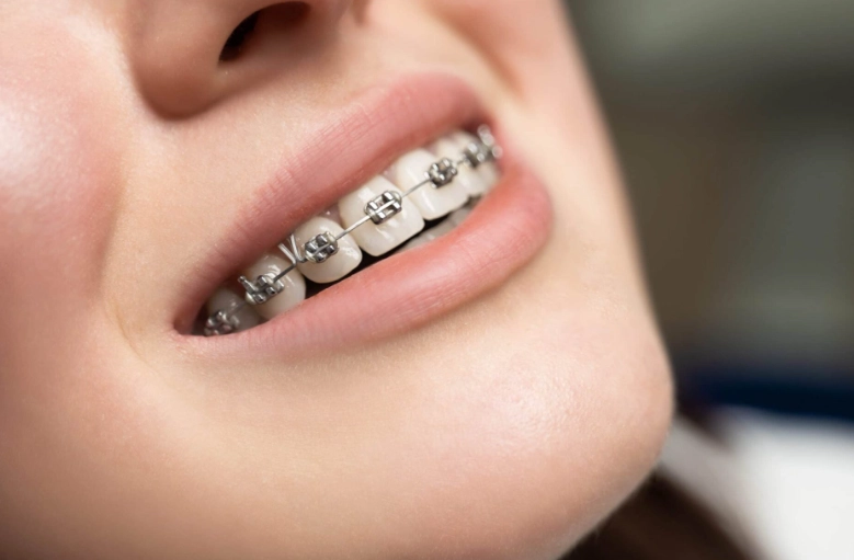 metal braces vs invisalign metal braces vs invisalign