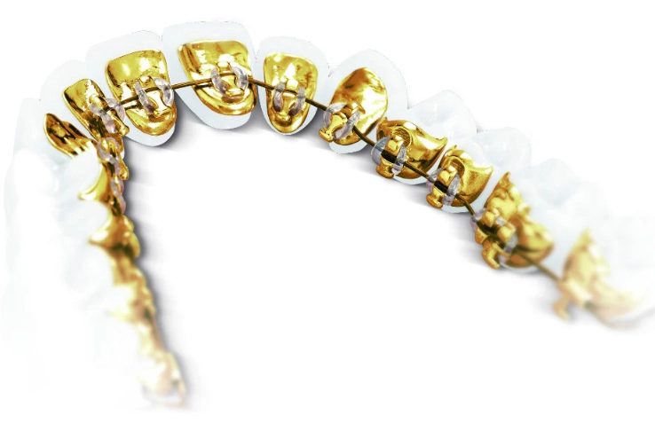 cost of lingual braces