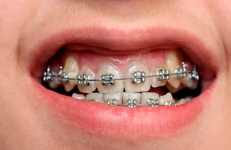 metal braces cost metal braces cost