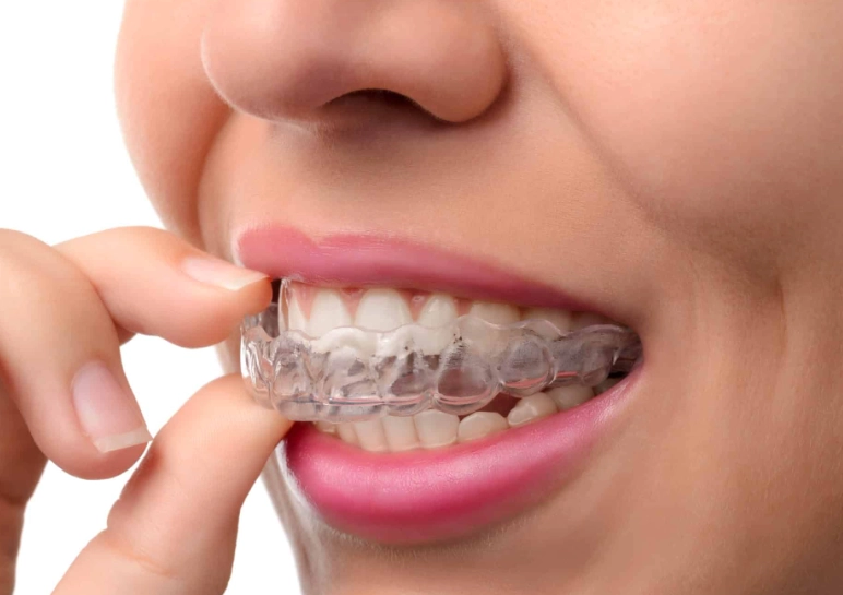 how do clear aligners work