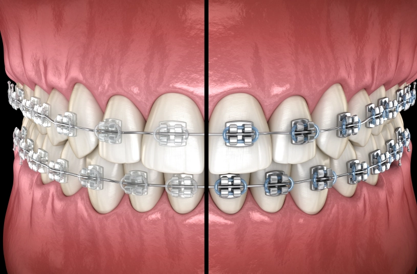 how to clean metal braces how to clean metal braces