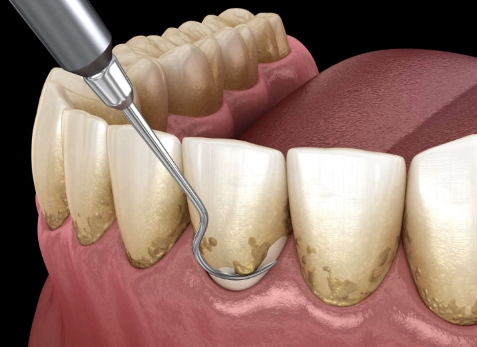 plaque removal at home