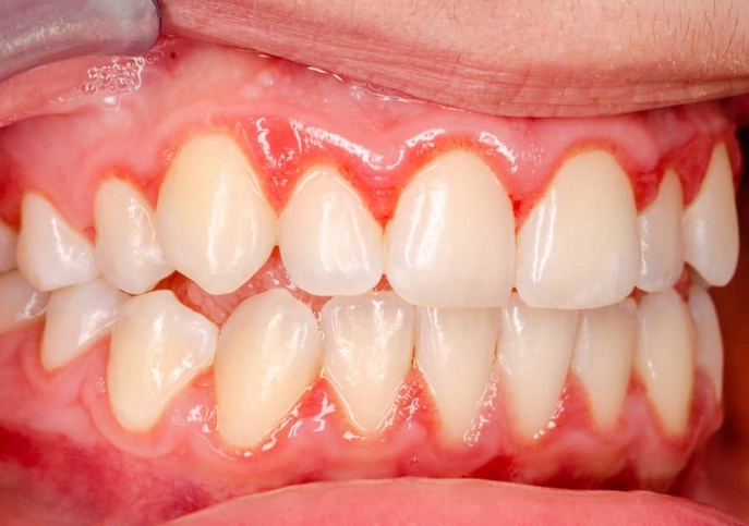 how to prevent gingivitis