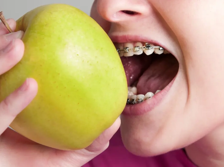 foods to avoid with braces