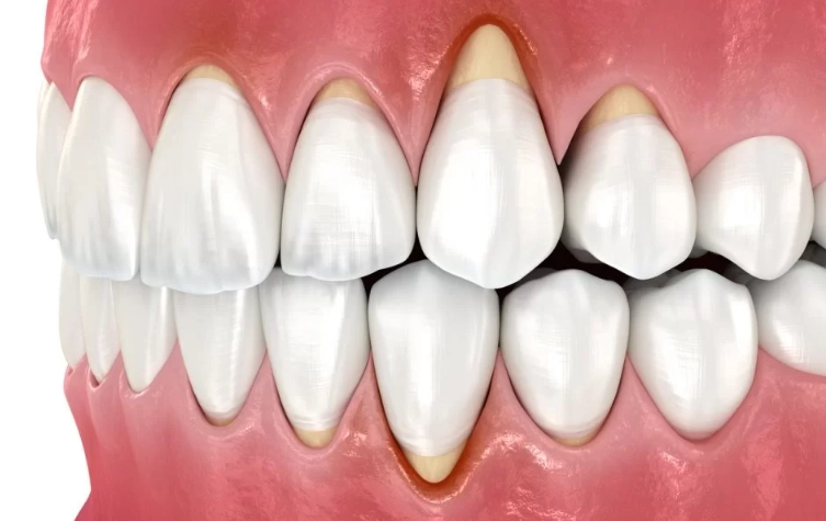 how to treat gum recession at home