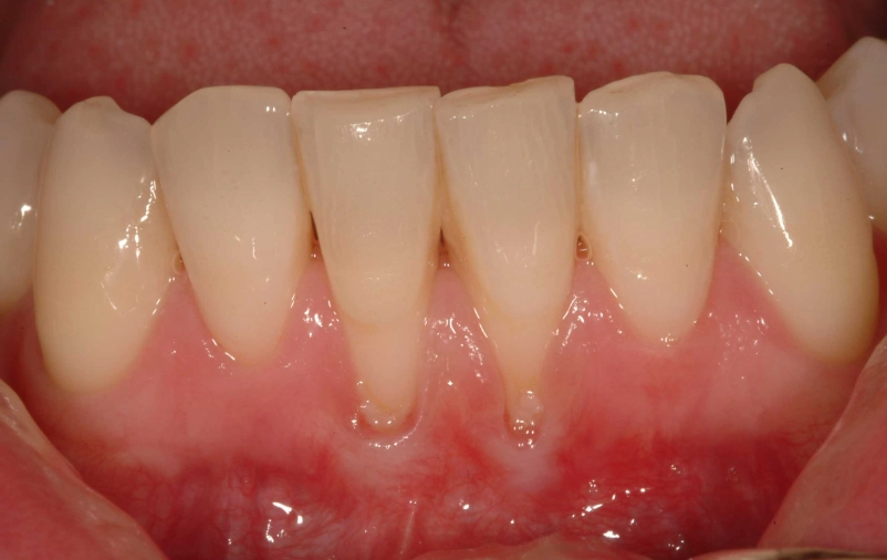 gum recession sensitivity