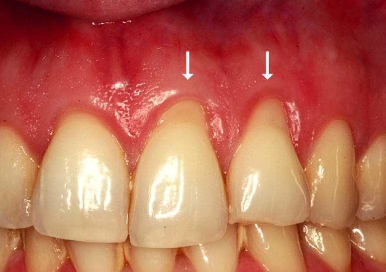 how to treat gum recession at home