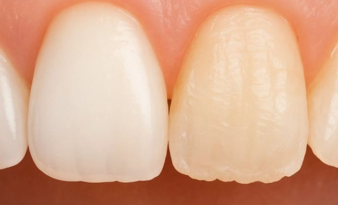 tooth sensitivity causes tooth sensitivity causes