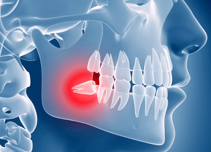 impacted wisdom tooth impacted wisdom tooth
