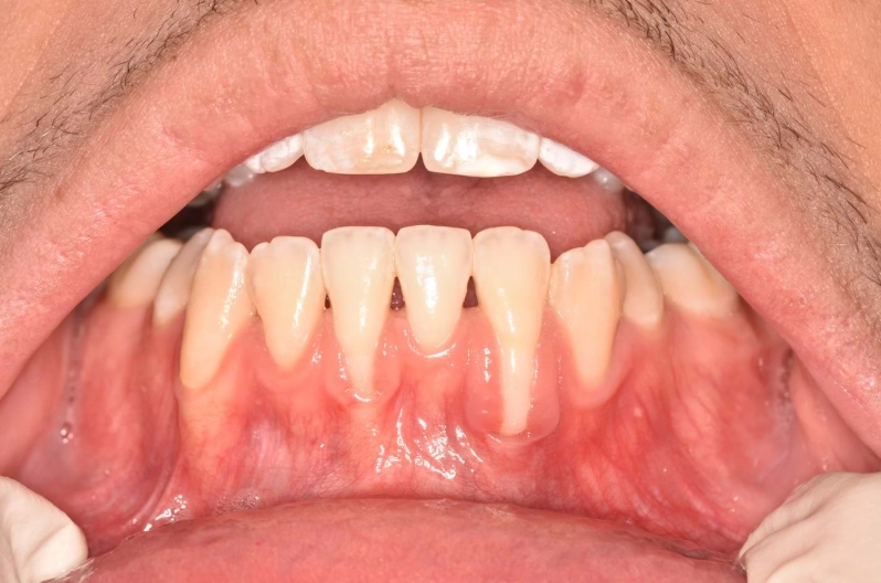 receding gums sensitive to cold