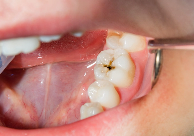 tooth sensitivity and cavities