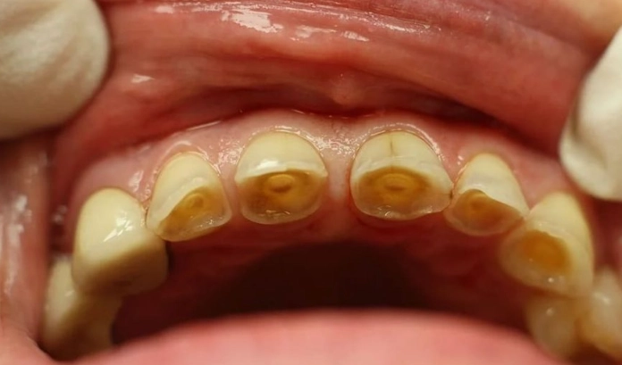 enamel erosion causes sensitivity