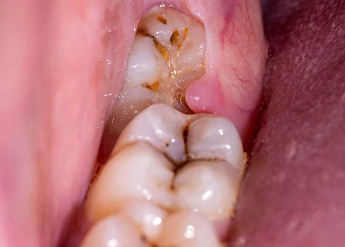 wisdom tooth pain relief wisdom tooth pain relief