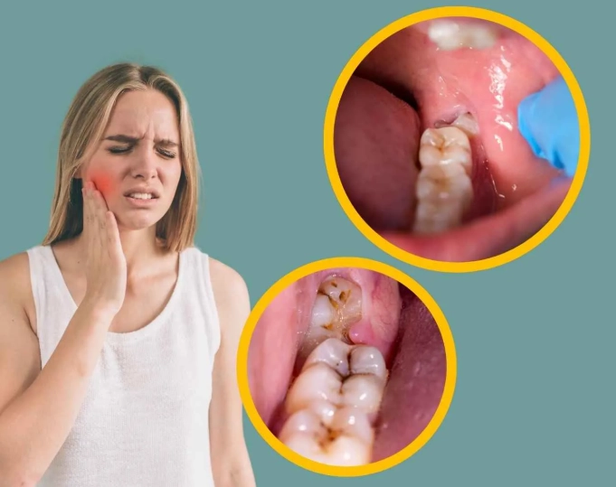 wisdom tooth pain relief wisdom tooth pain relief