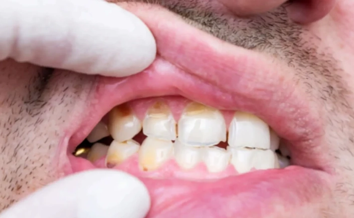 enamel erosion enamel erosion