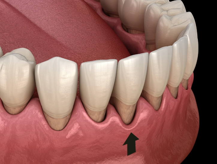 receding gums sensitive to cold