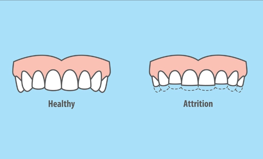 bruxism treatment bruxism treatment