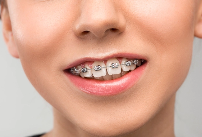 speed up braces treatment
