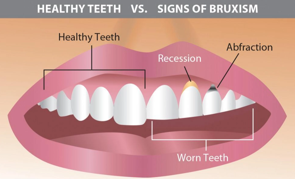 bruxism symptoms