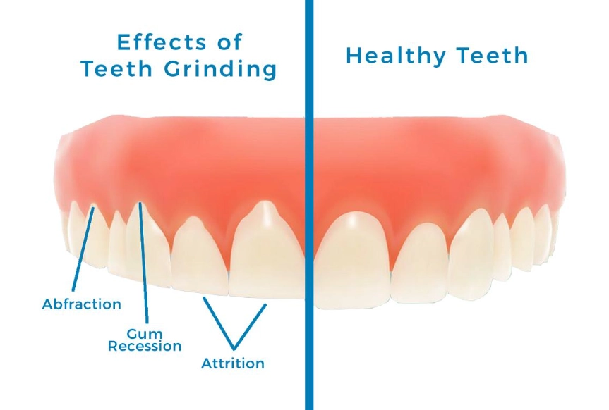 stop teeth grinding stop teeth grinding