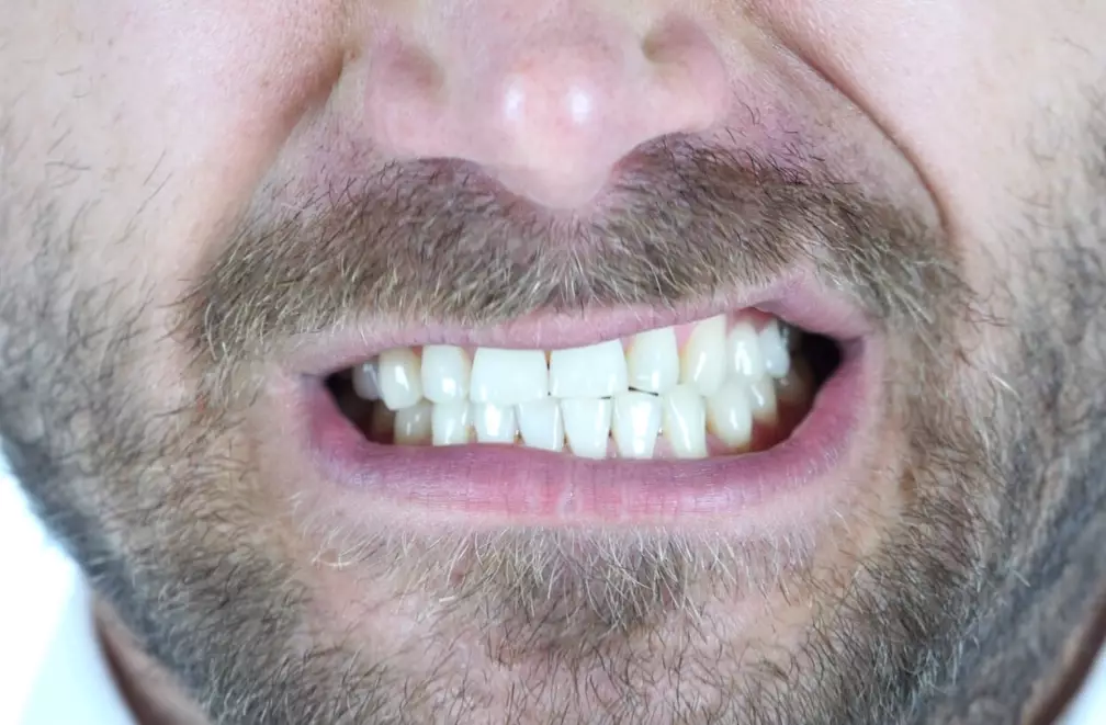 jaw pain from clenching