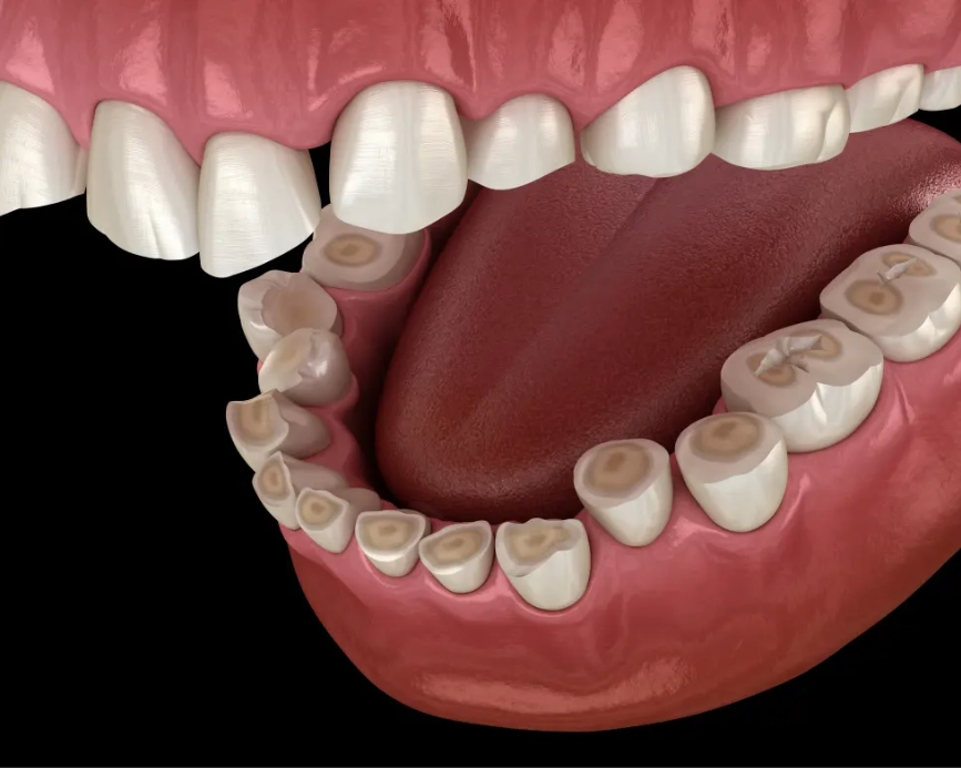 teeth grinding at night