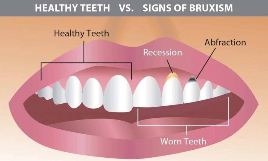 teeth grinding damage