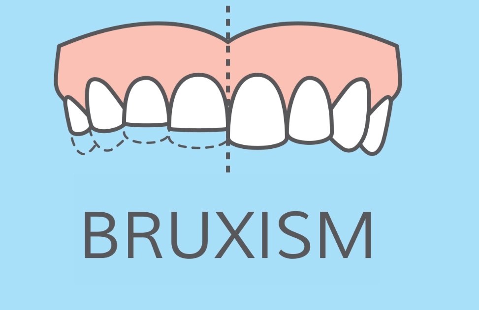 teeth grinding causes