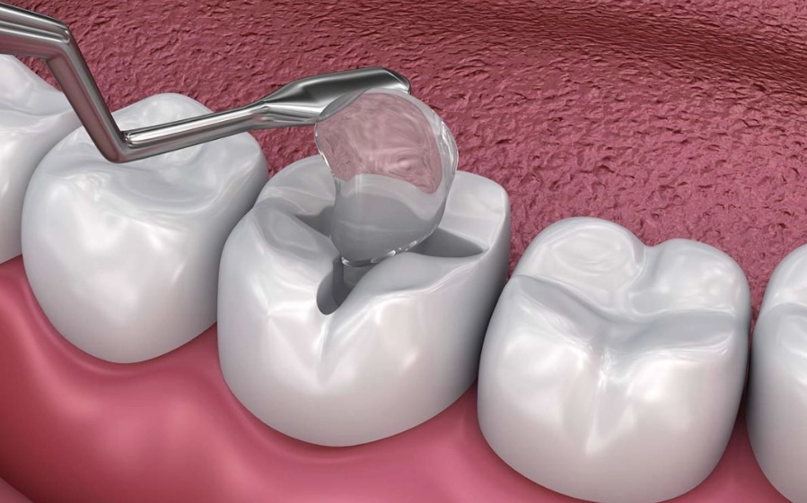 composite vs amalgam fillings