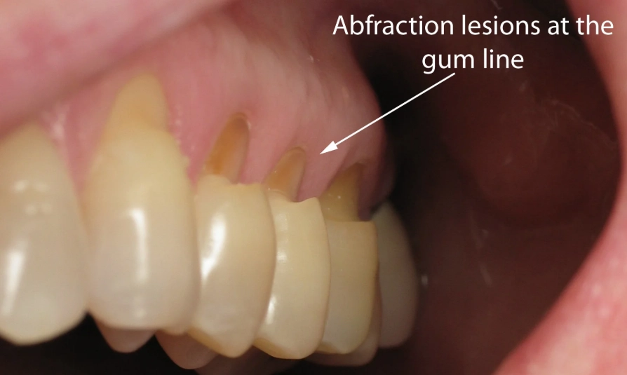 effects of teeth grinding