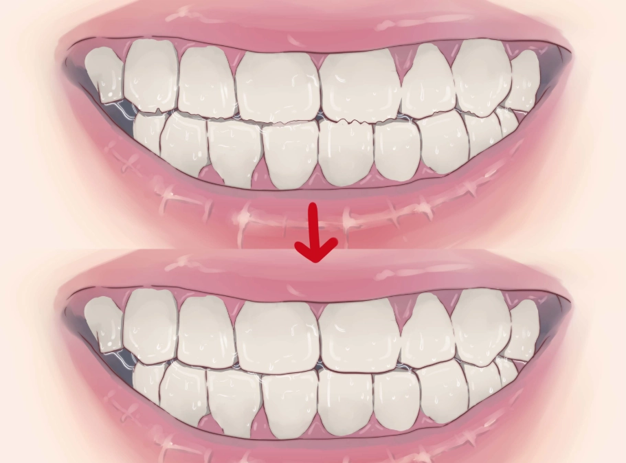 how to stop grinding teeth