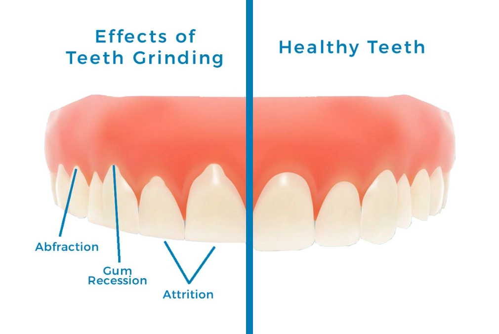teeth grinding at night