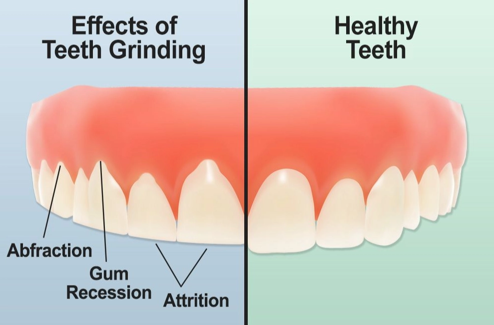 bruxism causes
