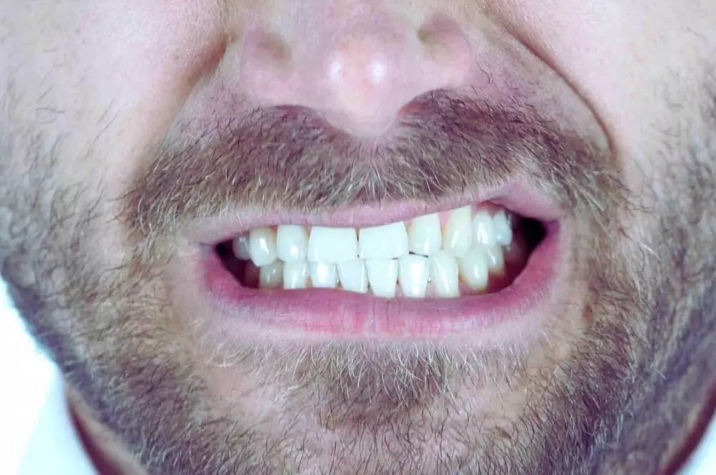 stop teeth grinding at night