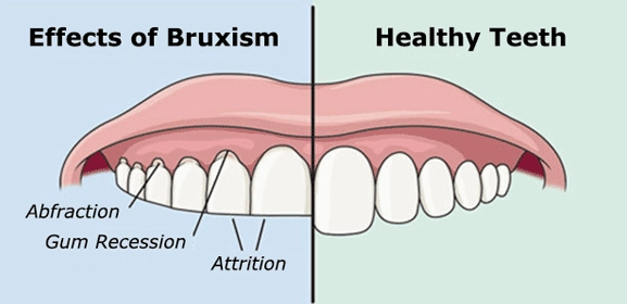 night guard alternatives