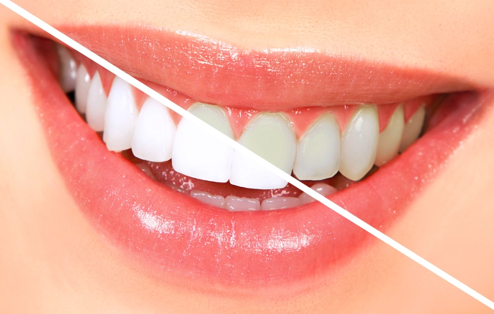 teeth whitening side effects