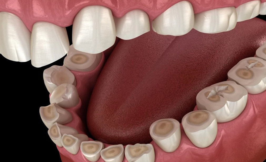 teeth grinding mouthguard