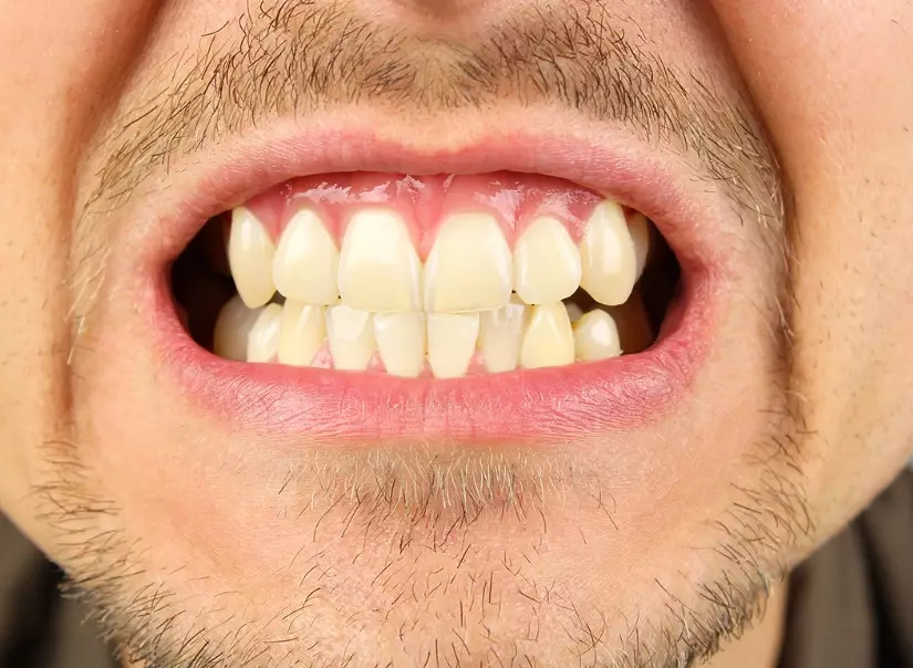 how to stop grinding teeth