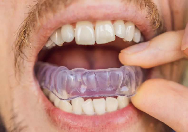 teeth wear from sleep grinding
