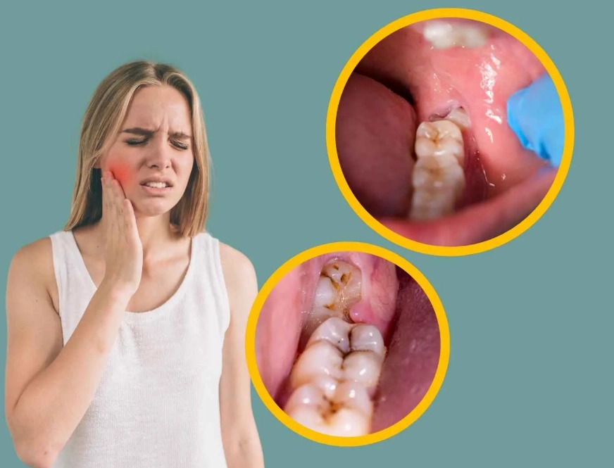 wisdom tooth home remedies