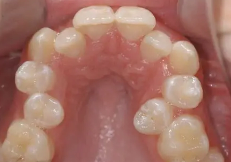 wisdom teeth and crowding