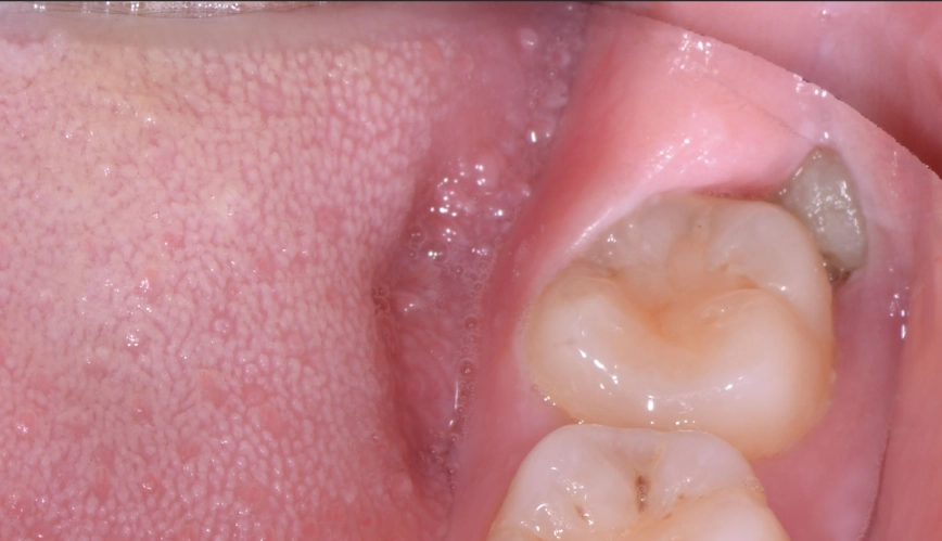 impacted wisdom tooth symptoms