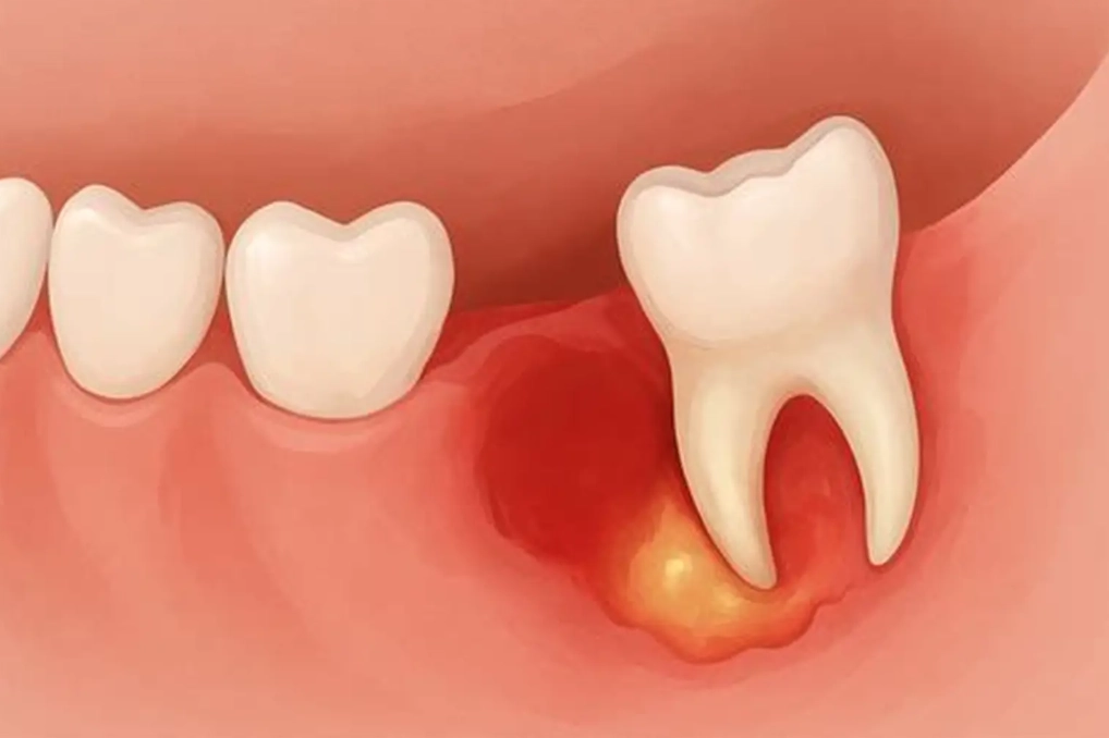 impacted wisdom tooth