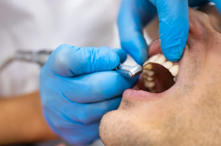 dry socket prevention tips