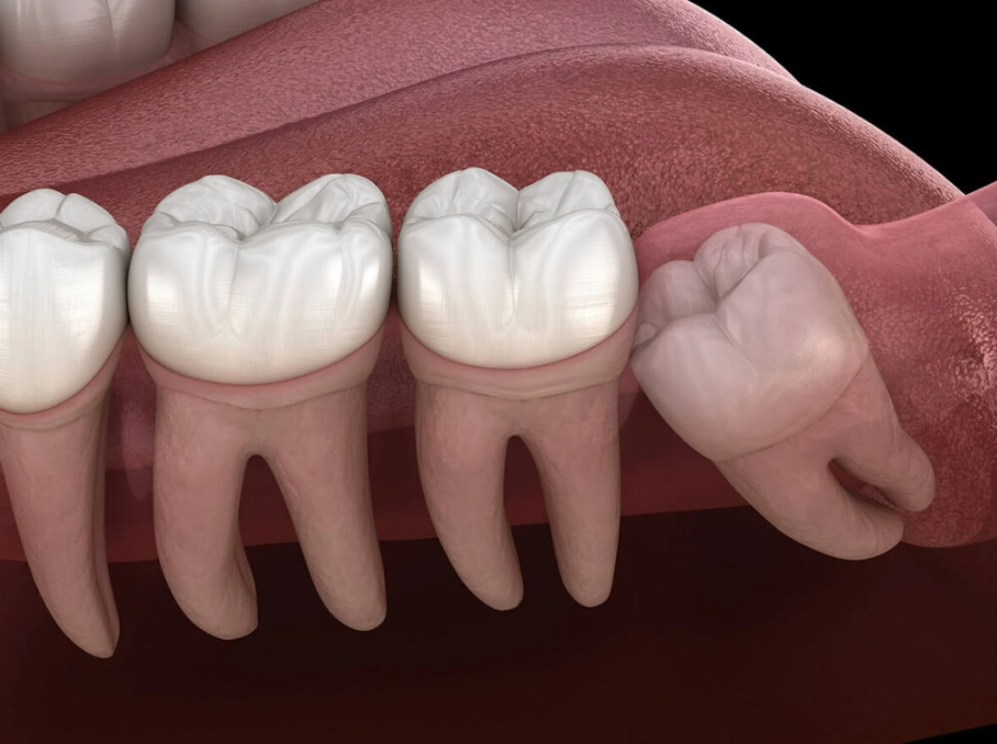 wisdom tooth extraction