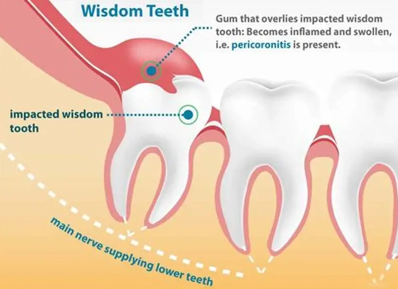 impacted wisdom tooth symptoms