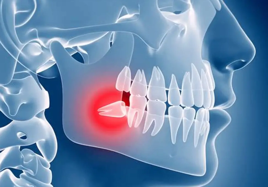 wisdom tooth home remedies