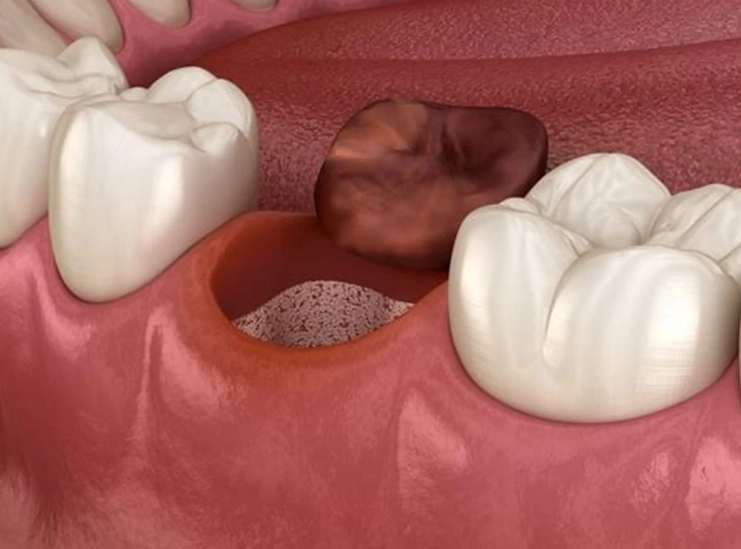 dry socket prevention tips