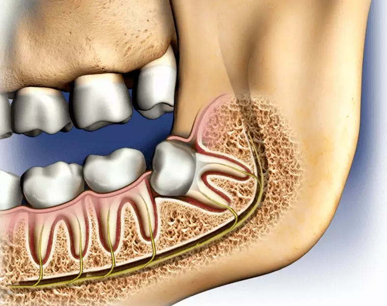 dry socket after wisdom tooth extraction