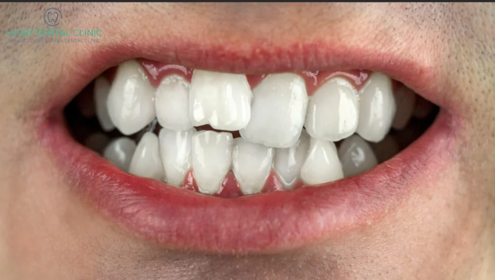 wisdom teeth crowding other teeth